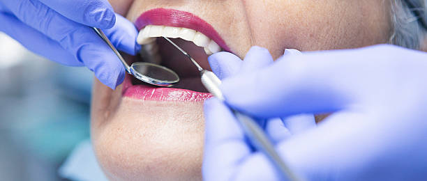 Best Emergency Wisdom Teeth Removal in Woodstock, IL
